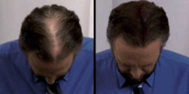The Key Benefits of Hair Building Fiber's