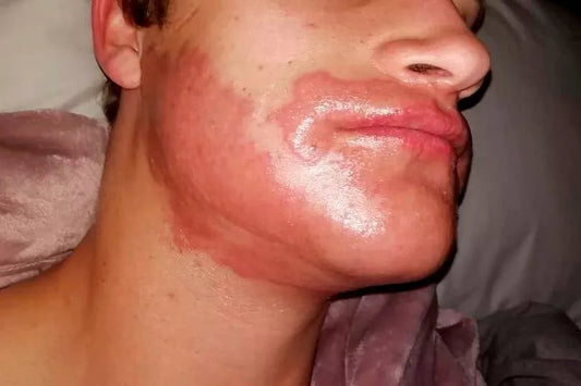 Beard Dye Allergies_contact dermatitis